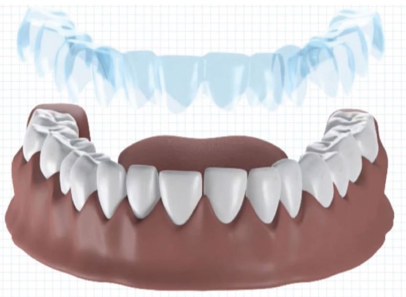 Dental-SLA®-DLP®-MOVINGLight®-case-study